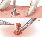 Lugonja Cosmedics biopsija koze | skin biopsy