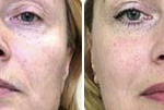 Middle strength microdermabrasion