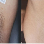 E-laser Hair removal