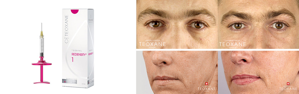 Teosyal Dermal Fillers | Redencity